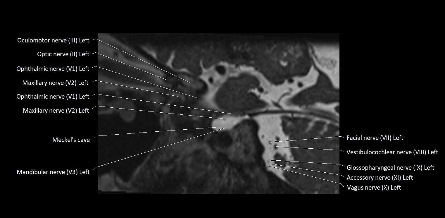 Cranial nerve sagittal anatomy MRI 3T image 19.webp